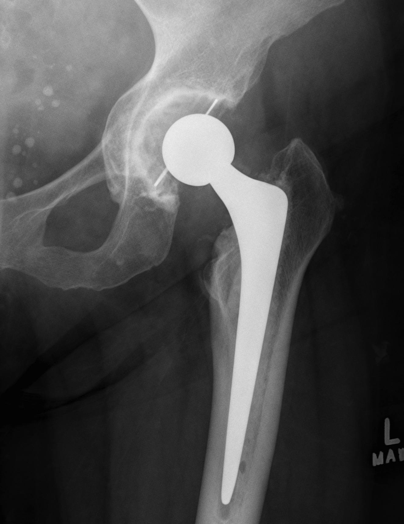 THR Protrusio Medial Morcellised Bone Graft